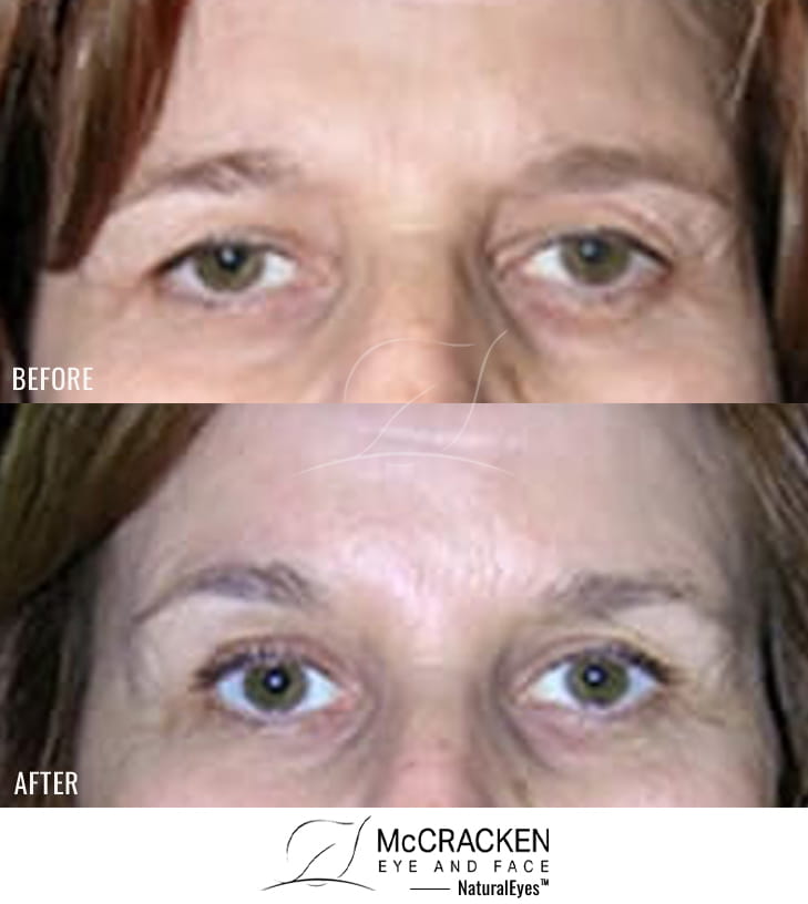60 Year Old Female – Upper Blepharoplasty and Endoscopic Brow Lift