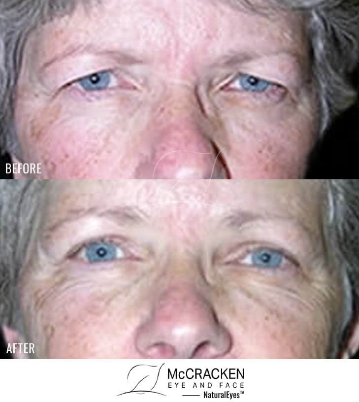58 Year Old Female – Upper Blepharoplasty and Endoscopic Brow Lift