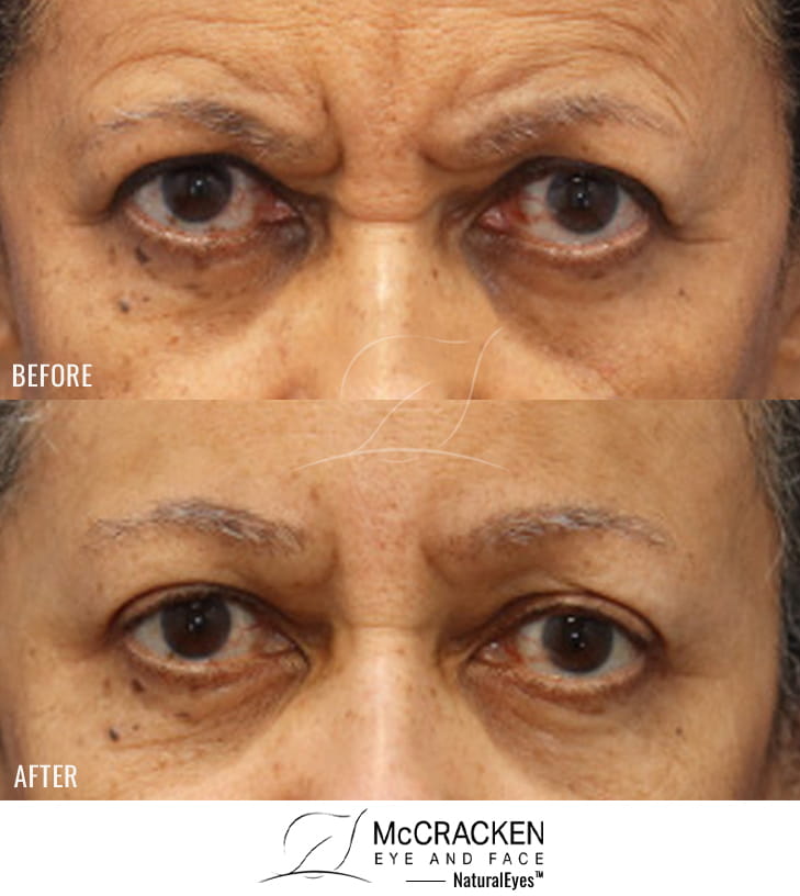 70 Year Old Female – Endoscopic Brow Lift fixated with EndoTines.