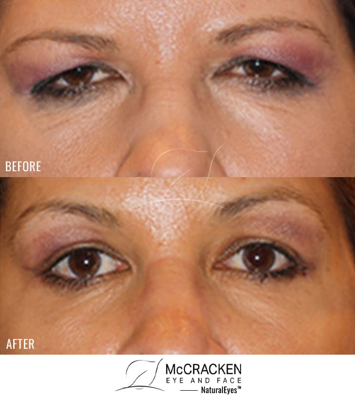 46 year old female – Full face fractional CO2 laser skin resurfacing, Endoscopic brow lift