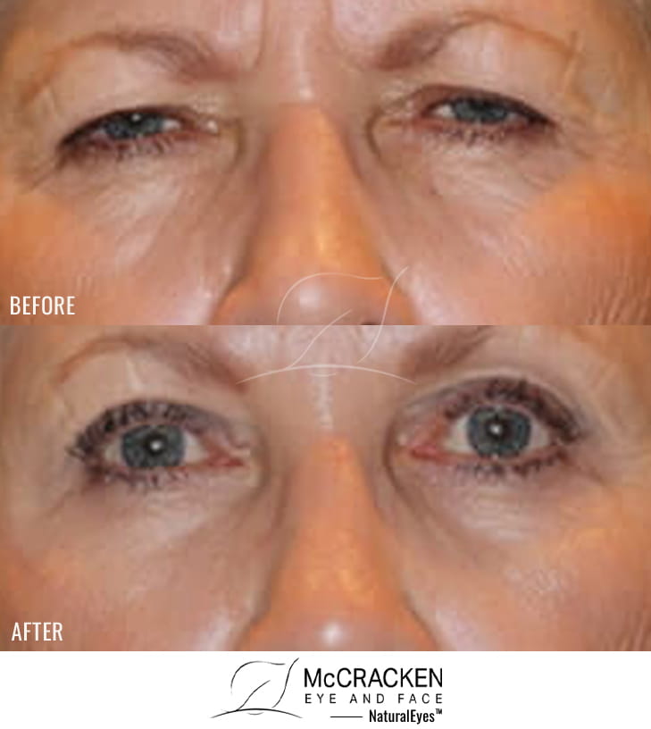67 year old female – Full face fractional CO2 laser skin resurfacing, Bilateral endoscopic brow lift Bilateral upper and lower lid blepharoplasty