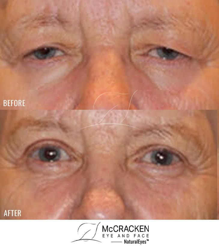 71 year old female – Full face fractional CO2 laser skin resurfacing, Bilateral upper lid blepharoplasty Left brow lift