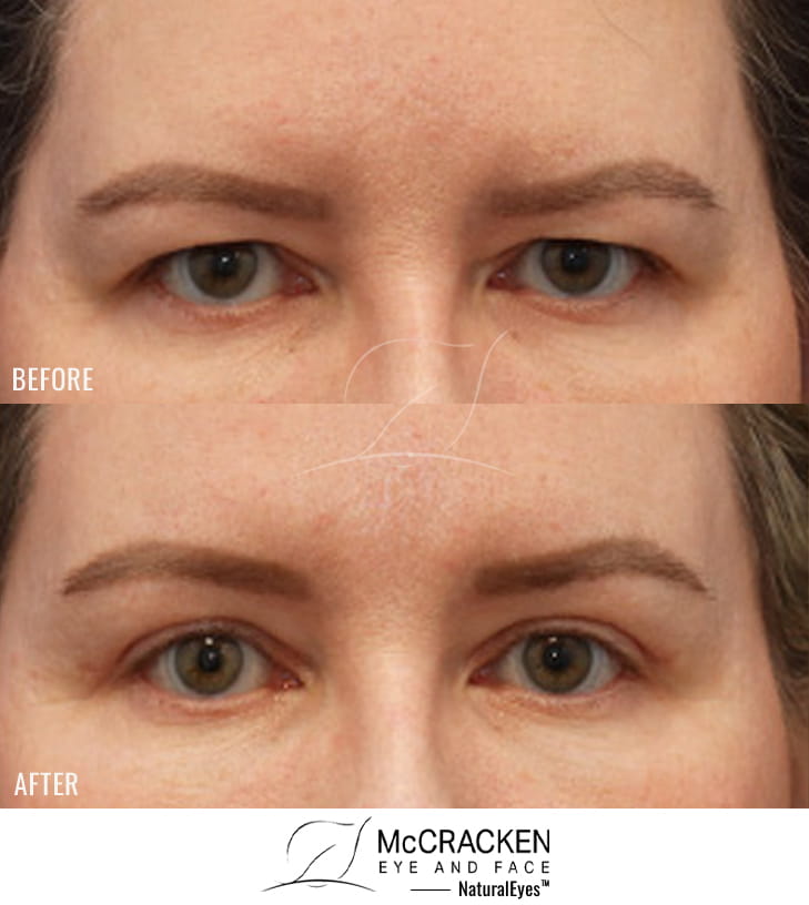 47 Year Old Female – Endoscopic Brow Lift with Upper Blepharoplasty. The brow lift was fixated with EndoTines.