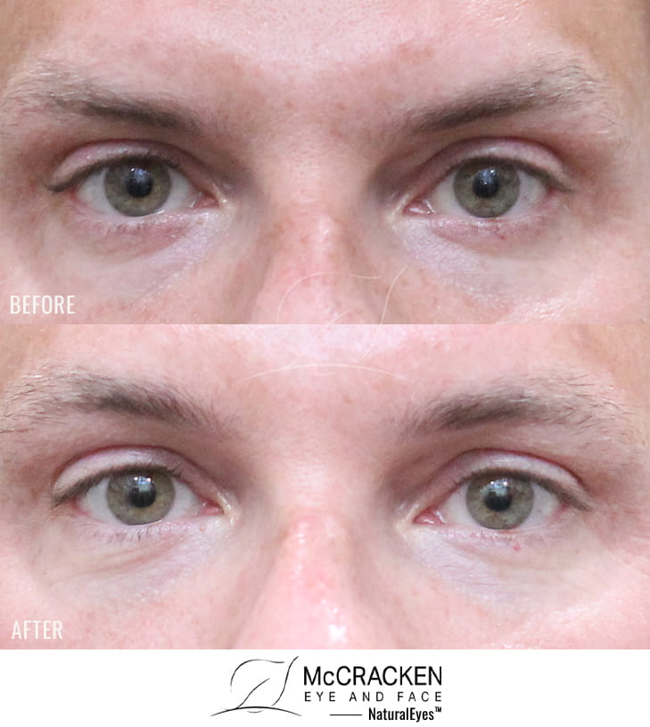 42 Year Old Male – Brow Lift. This patient desired elevation of the central brow. He underwent a central endoscopic brow lift with Endotine fixation.