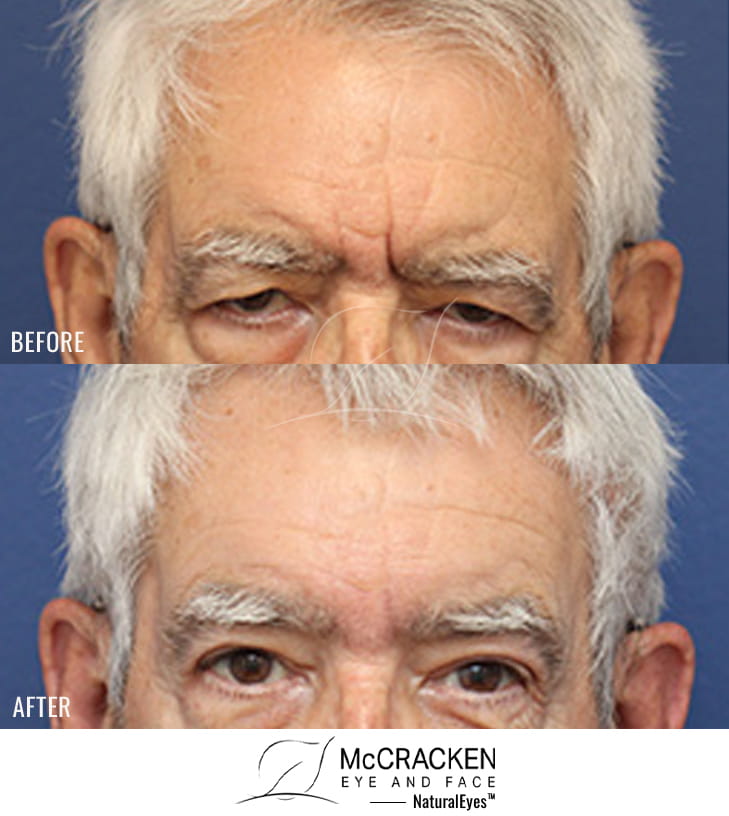 81 Year Old Male – Upper Blepharoplasty and Brow Lift. The brow lift was an endoscopic brow lift with Endotine fixation.