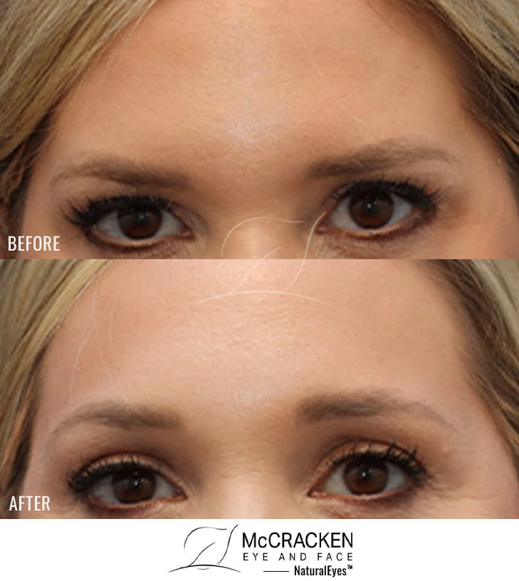 42 Year Old Female – Endoscopic Brow Lift with Lower Blepharoplasty, Fat Transfer to the Cheeks (2cc on the Right and 3cc on the Left), and NanoFat Injection 1cc to each Lower Lid. The brow lift was fixated with EndoTines. No lower lid skin incisions were made.