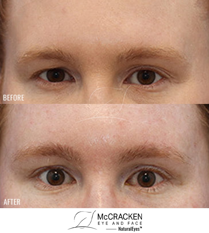 34 Year Old Female – Endoscopic Brow Lift Fixated with EndoTines. The Patient is Shown 1 Week Postop.
