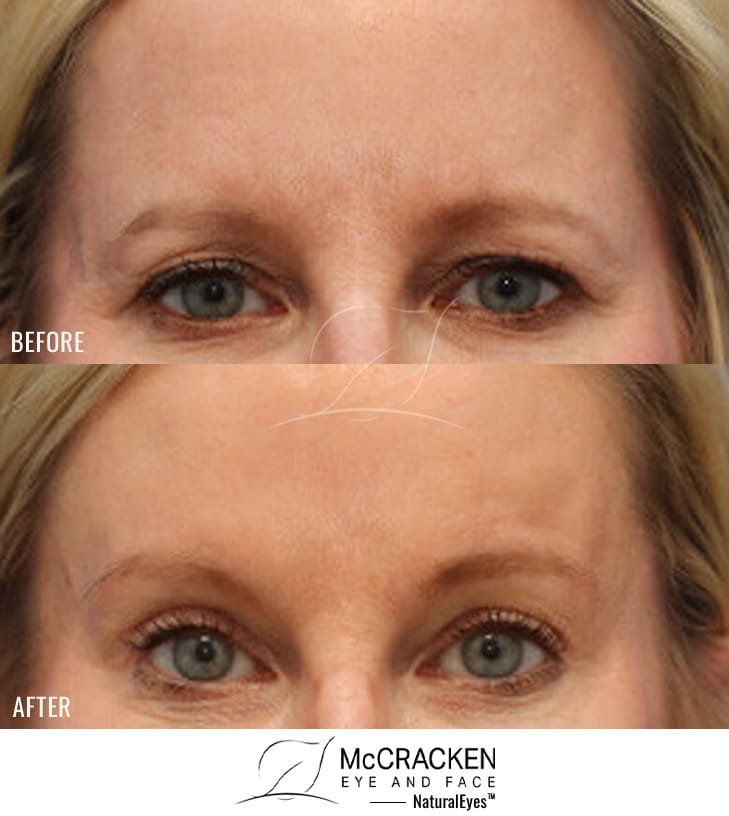 54 Year Old Female – Endoscopic Brow Lift with Upper Blepharoplasty. The brow lift was fixated with EndoTines.