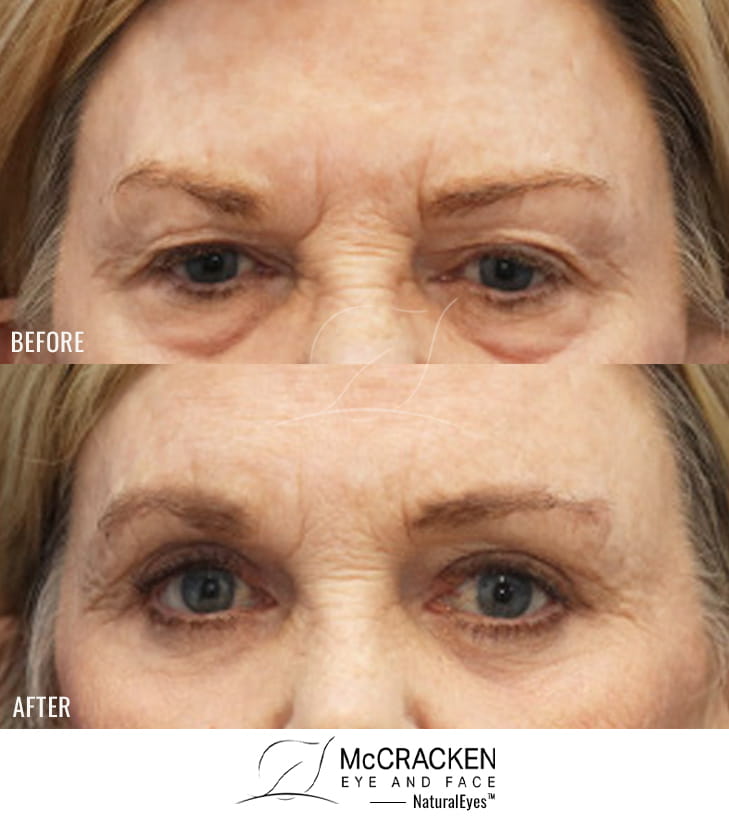 54 Year Old Female – Endoscopic Brow Lift with Upper Lid Blepharoplasty, Lower Lid Blepharoplasty with Fat Excision, Fat Transfer to the Cheeks (5.5 cc on the Right and 3.5 cc on the Left), and Periocular Laser Skin Resurfacing. The brow lift was fixated with EndoTines. No Lower Lid Skin Incisions Were Made.