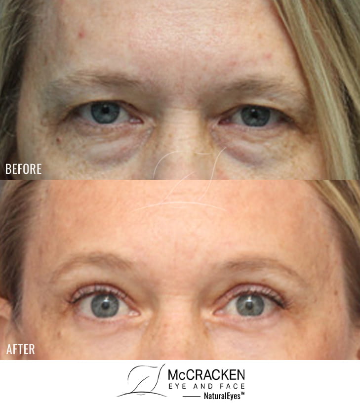 54 Year Old Female – Endoscopic Brow Lift with Upper and Lower Blepharoplasty and laser skin resurfacing. The brow lift was fixated with EndoTines. No lower lid skin incisions were made.