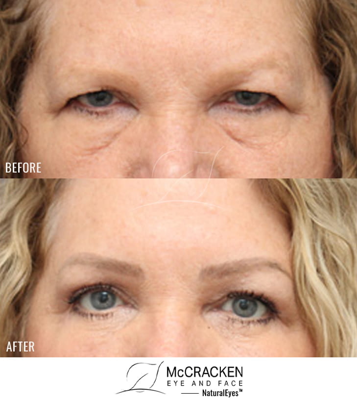 65 Year Old Female – Bilateral Endoscopic Brow Lift with Upper and Lower Lid Blepharoplasty with Laser Skin Resurfacing. The brow lift was fixated with EndoTines and the lower lid blepharoplasty was performed with a skin muscle flap.