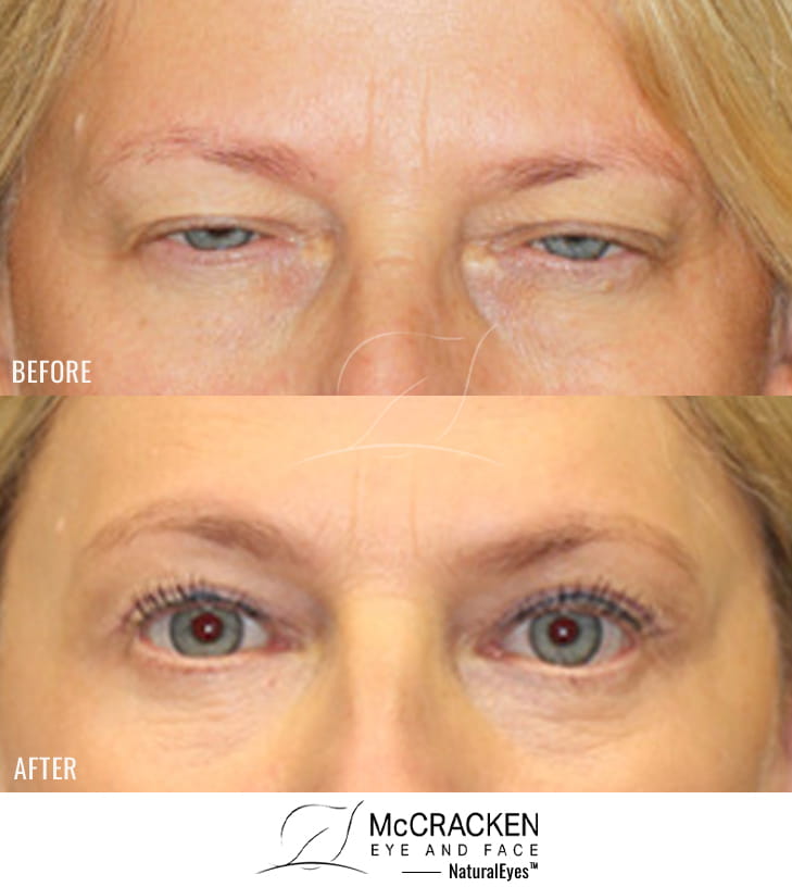 54 Year Old Female – Brow Lift, Upper and Lower Blepharoplasty, and Periocular Laser Skin Resurfacing