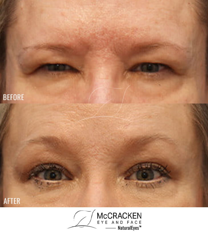 57 Year Old Female – Bilateral Endoscopic Brow Lift with EndoTine Fixation.