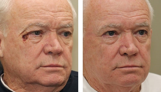  Before and After Picture  
72 year old male - Repair of right lateral canthal defect after excision of basal cell carcinoma.