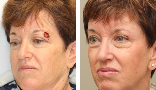  Before and After Picture  
54 year old female - repair of left upper lid and brow defect after Mohs excision of basal cell carcinoma.