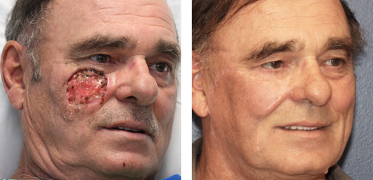  Before and After Picture 
68 year old male – Repair of Left Upper Lid Defect after excision of melanoma in situ.