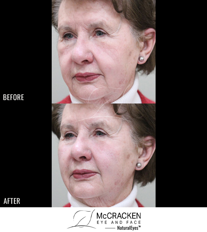 83 Year Old Female – Cheek Augmentation with 3 Syringes of Voluma