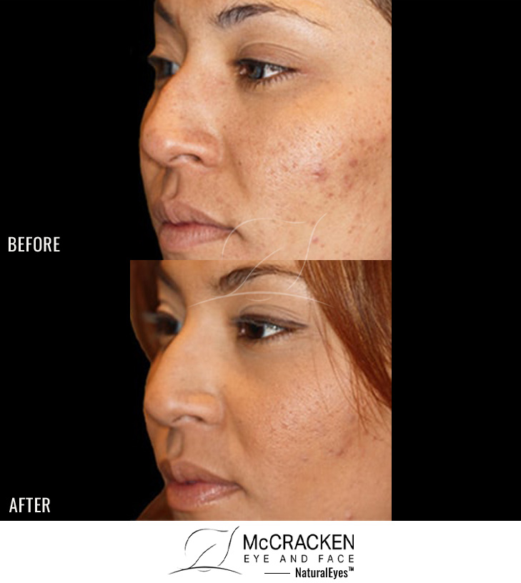29 Year Old Female – Restylane® to Nose