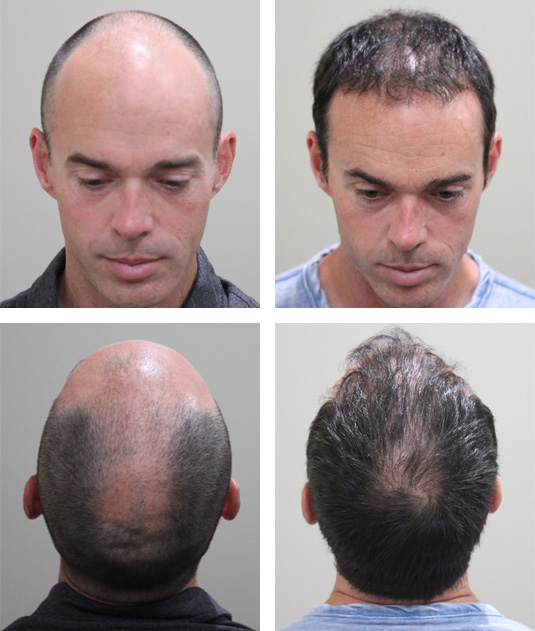  Before and After Picture 
43 Year old male, 7 months after 3000 grafts to hairline and crown.