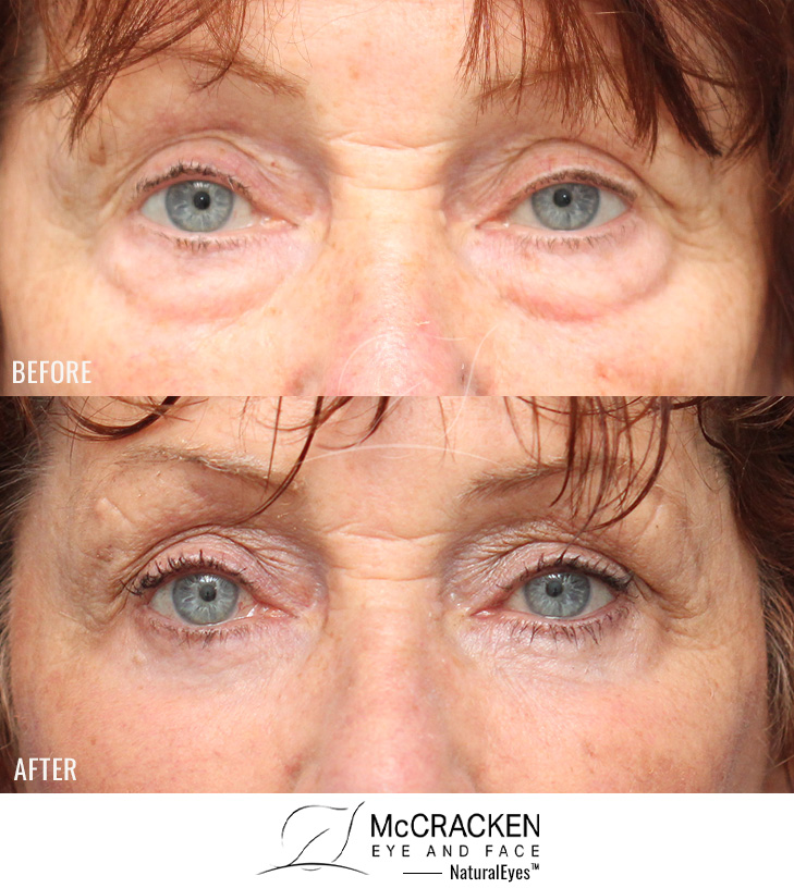 71 Year Old Female Lower Lid Blepharoplasty with Skin Pinch Excision.