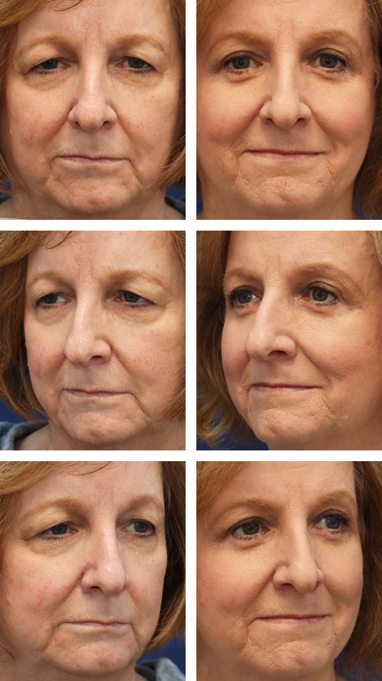  Before and After Picture 
74 Year Old Female – Upper and Lower Blepharoplasty (Skin Muscle Flap Excision for Lower Lids)