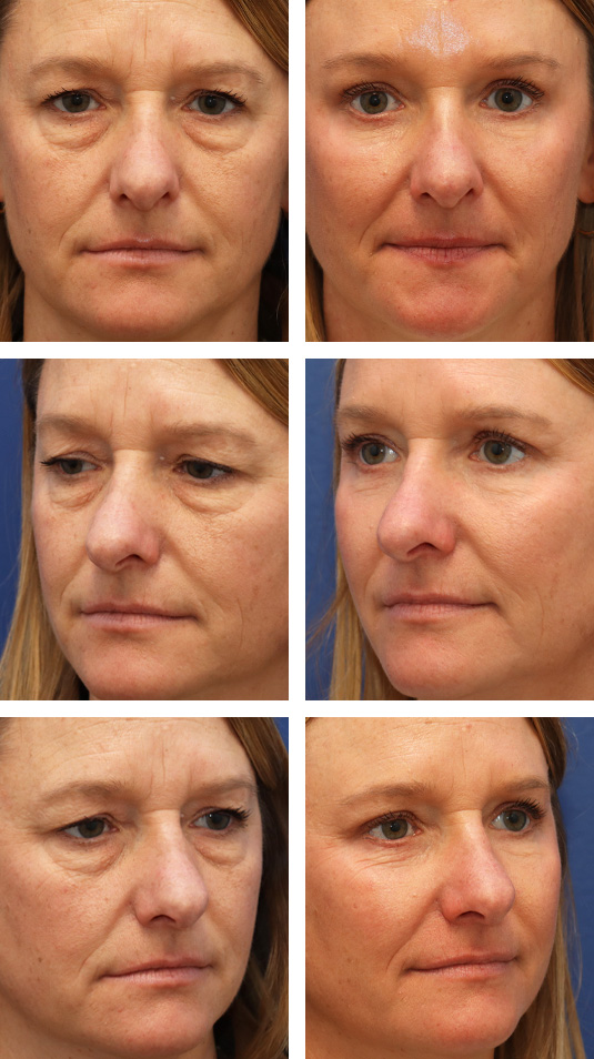  Before and After Picture 
45 Year Old Female – Temporal Brow Lift, Upper and Lower Lid Blepharoplasty with Fat Repositioning and lower lid skin pinch excision, Injection of 4cc of Fat to Each Cheek, and Laser Skin Resurfacing.
