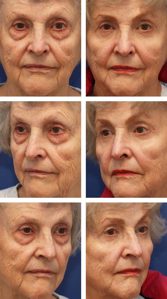  Before and After Picture 
74 Year Old Female – Upper Blepharoplasty (Excision of Right upper lid skin and Trimming of Both Upper Lid Fat Pads) and Lower Blepharoplasty (Skin Muscle Flap Excision for Lower Lids)