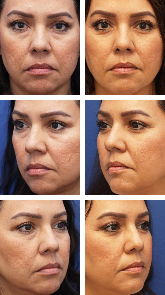  Before and After Picture 
43 Year Old Female – Lower Lid Blepharoplasty with Fat Repositioning and Injection of 3cc of Fat to Each Cheek. No Lower Lid Skin Incisions were made.