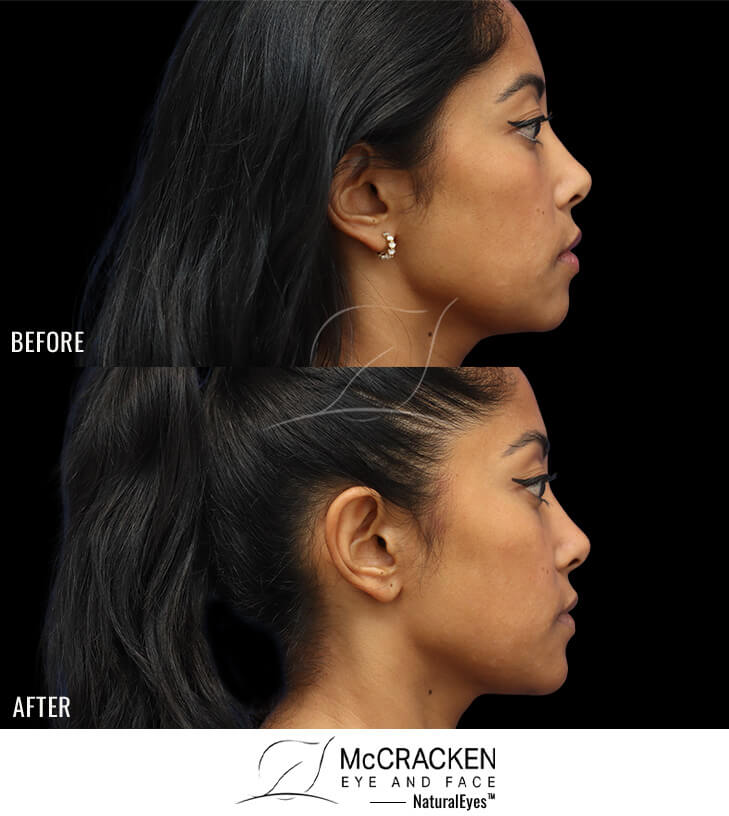 38 Year Old Female;Injection of 1cc Vollux to Chin