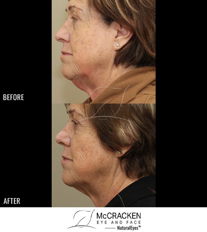 69 year old Female – Kybella (2 treatments)