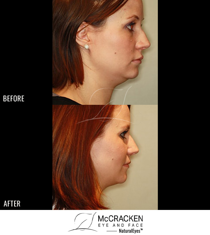 26 Year Old Female – Kybella