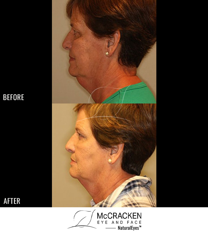 63 Year Old Female – Kybella