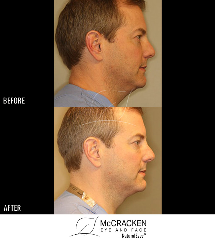 46 Year Old Male – Kybella