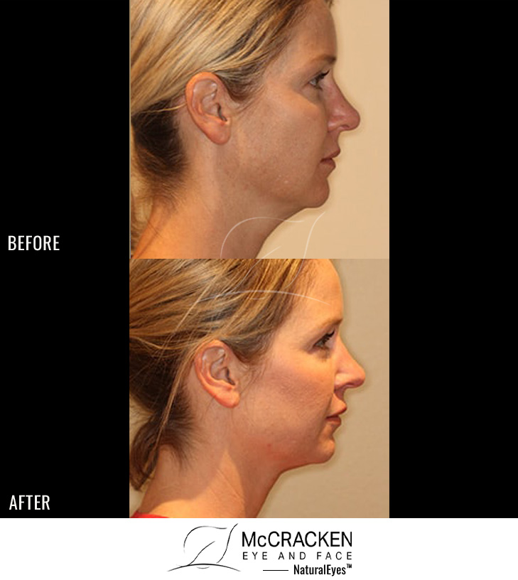 44 year old female pre one kybella treatment