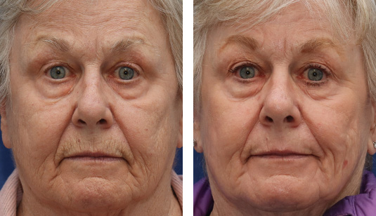  Before and After Picture 
71 year old female – 5 Months after Full Face Sciton Laser Skin Resurfacing