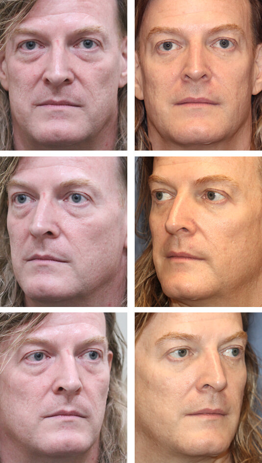  Before and After Picture  
51 Year Old Male – Upper and Lower Blepharoplasty with Laser Skin Resurfacing. No skin incisions.