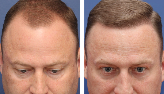  Before and After Picture 
49yo male 1y s/p 2500 grafts to hairline.