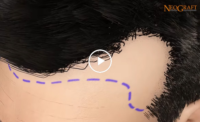 NeoGraft Hair Transplant System Explained Follicular Unit Extraction FUE