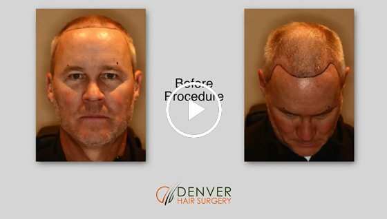 NeoGraft Hair Transplant Testimonial - Denver Hair Surgery