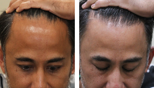  Before and After Picture 
44 Year Old Male, 1 Year After 2020 Grafts to Hairline