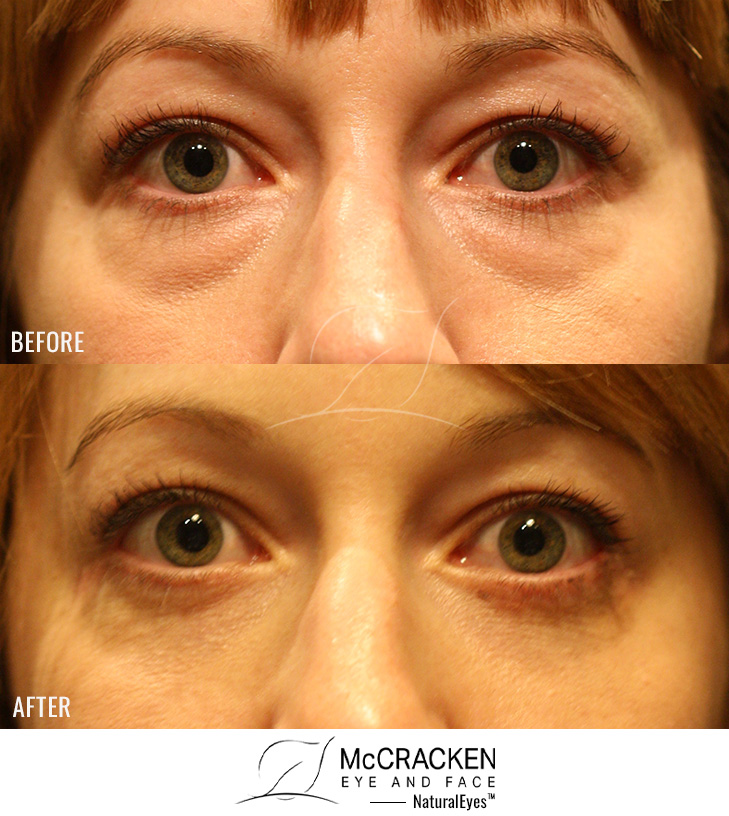 31 year old female – Lower Blepharoplasty