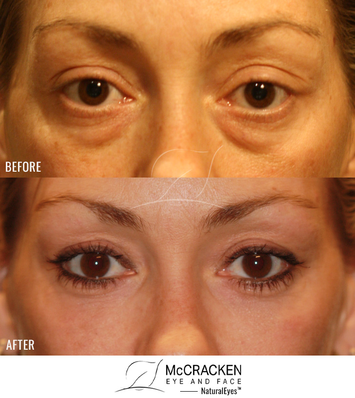 41 Year Old Female – Lower Blepharoplasty with Periocular Laser Skin Resurfacing
