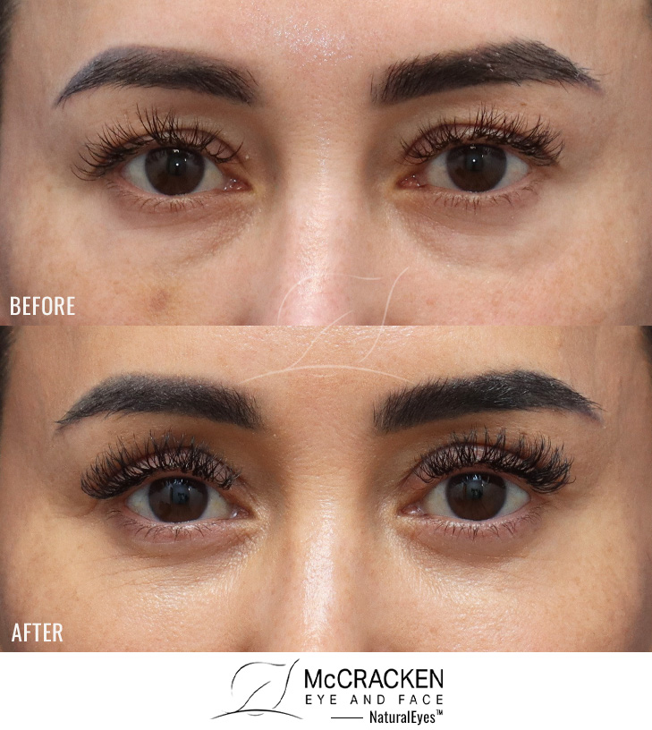41 Year Old Female: Upper and Lower Lid Blepharoplasty, Injection of 4cc of Fat to Each Cheek, and Injection of 1cc of Nanofat per Lower Lid. No Lower Lid Skin Incisions Were Made.