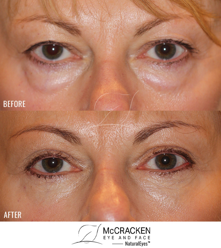56 Year Old Female – Upper and Lower Blepharoplasty