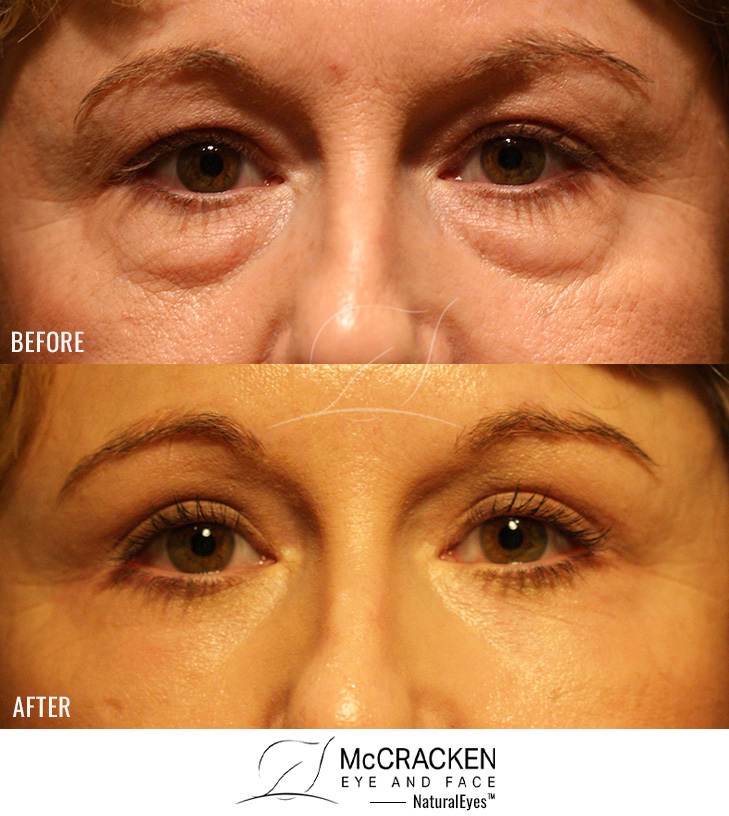 44 Year Old Female – Upper and Lower Blepharoplasty with Full Face Laser Resurfacing