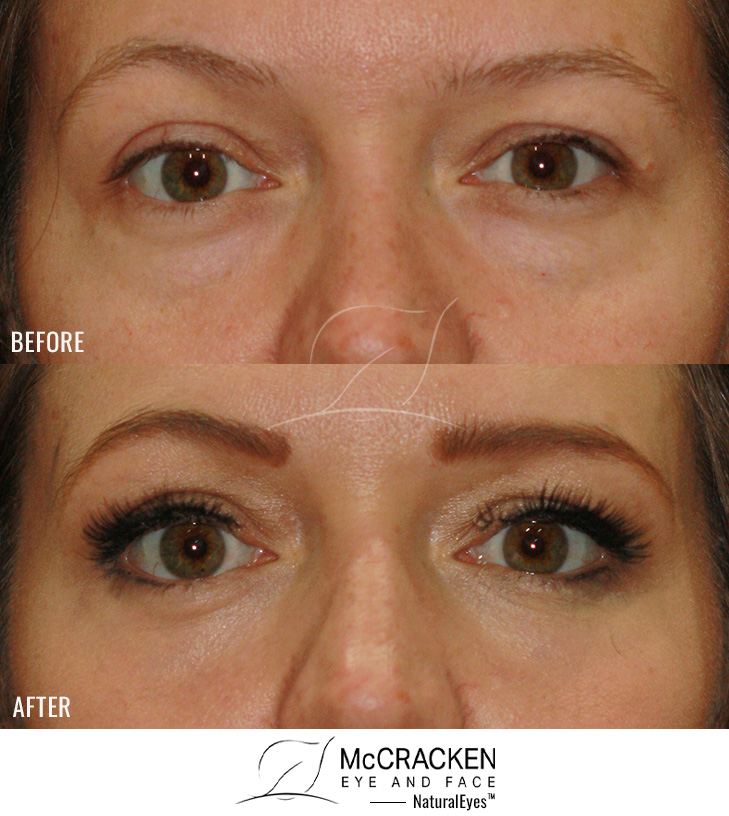 36 Year Old Female – Lower Blepharoplasty with Periocular Laser Skin Resurfacing