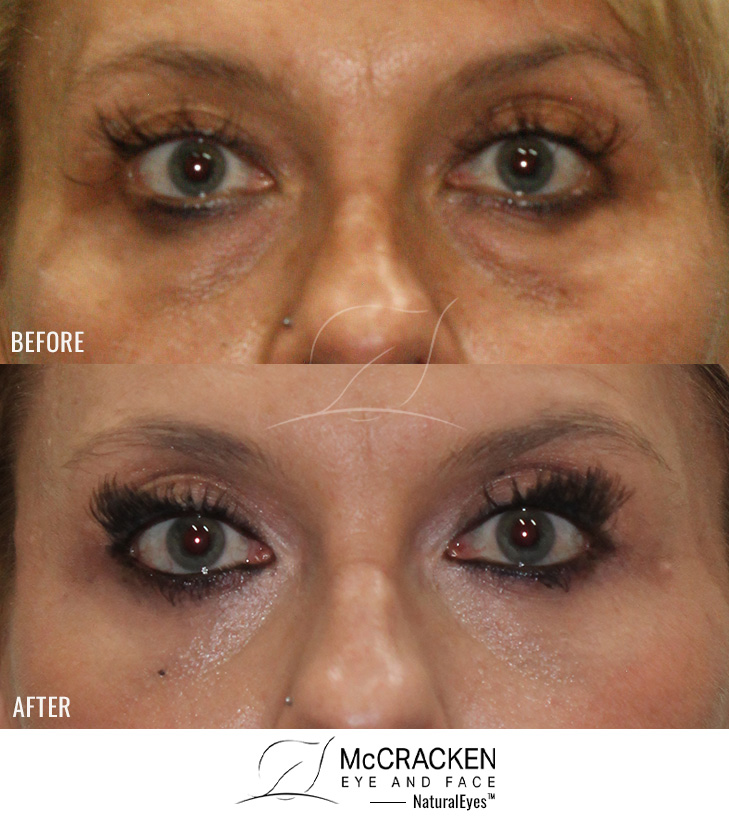 45 Year Old Female: Lower Blepharoplasty with Periocular Laser Skin Resurfacing