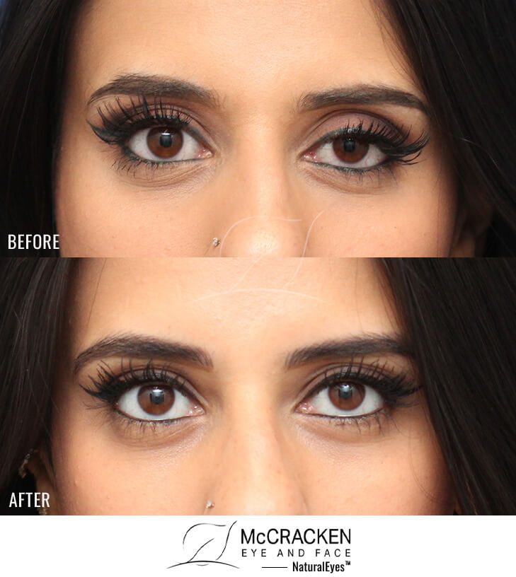 25 year old female – Left Upper Eyelid Ptosis (Droopy Eyelid) Repair. Dr McCracken was able to restore symmetry by lifting the left upper lid from the inside, with no skin incision.