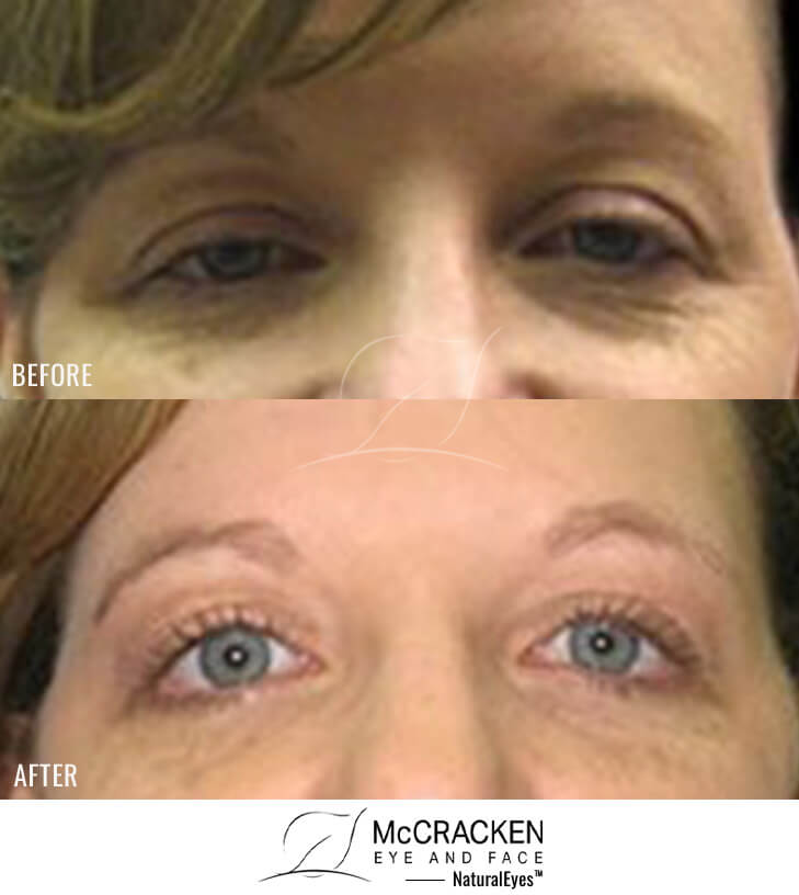 36 Year Old Female – Bilateral Upper Eyelid Ptosis (Droopy Eyelids) Repair