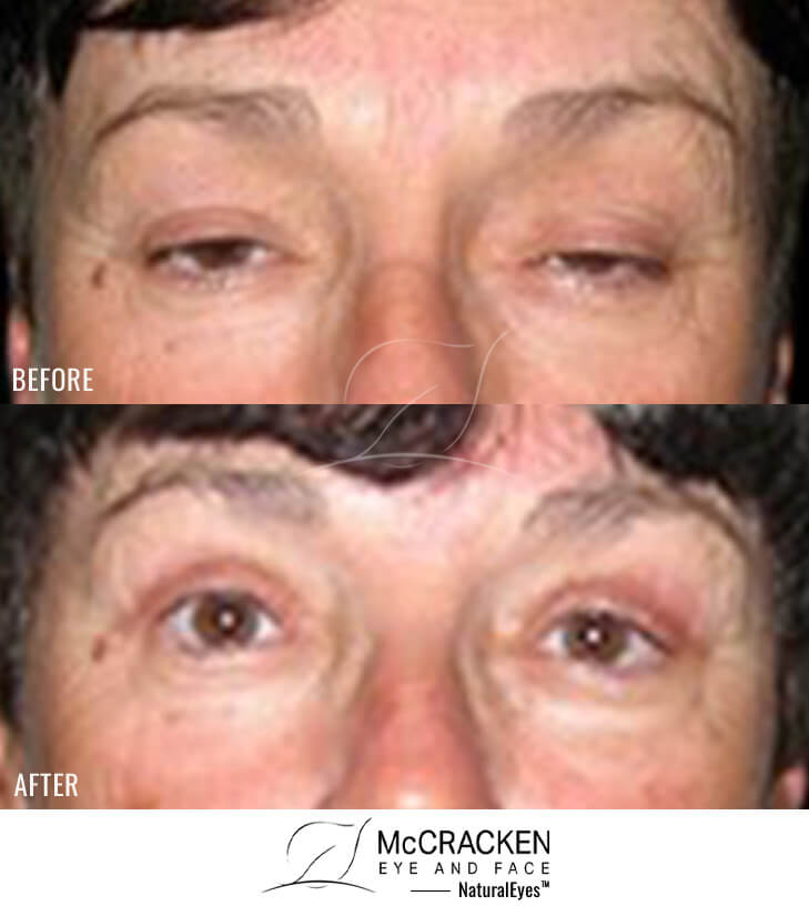 62 Year Old Female – Bilateral Upper Eyelid Ptosis (Droopy Eyelids) Repair